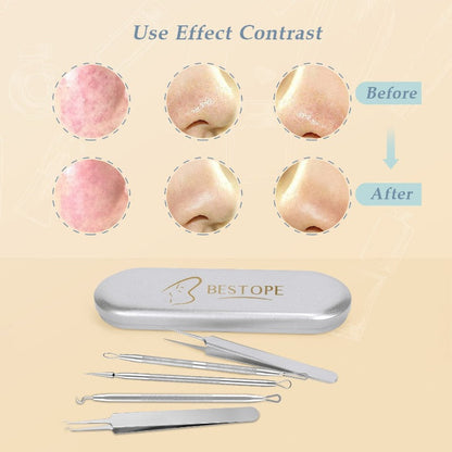 Ustar BESTOPE 26 PCs Makeup Set, 20pcs Brushes & 6pcs Blackhead Remover Pimple Extractor Tool