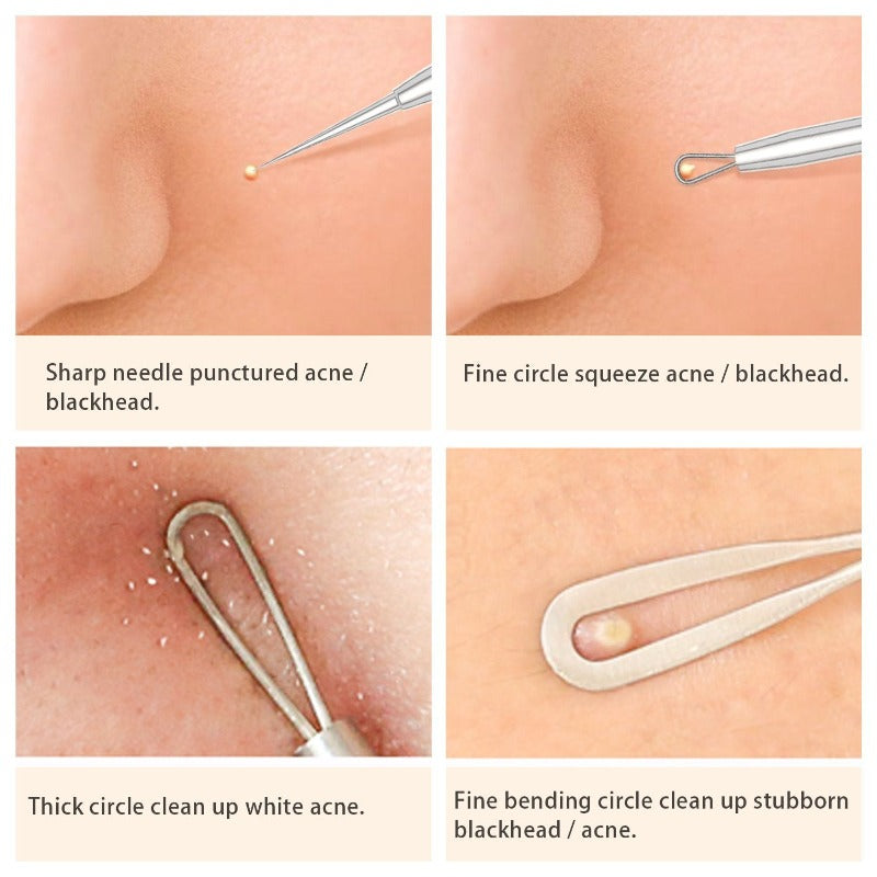 BESTOPE Blackhead Remover Pimple Extractor Tool With De La Cruz 10% Sulfur Ointment Acne Medication