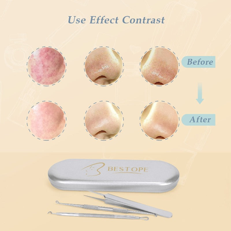 Acne Removal Kit
