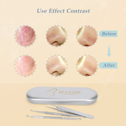 Acne Removal Kit